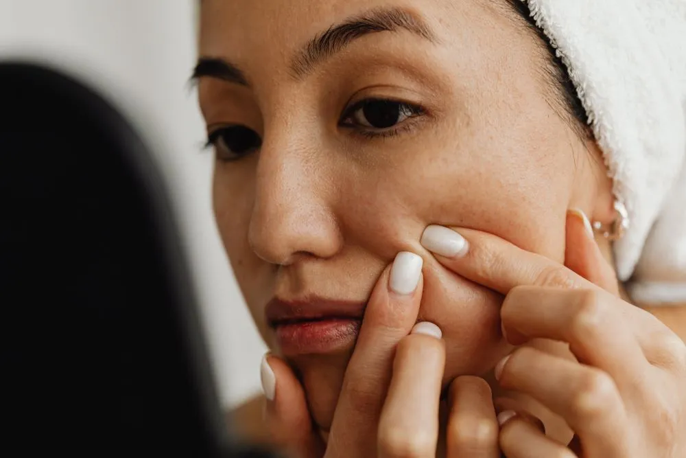 Blackheads