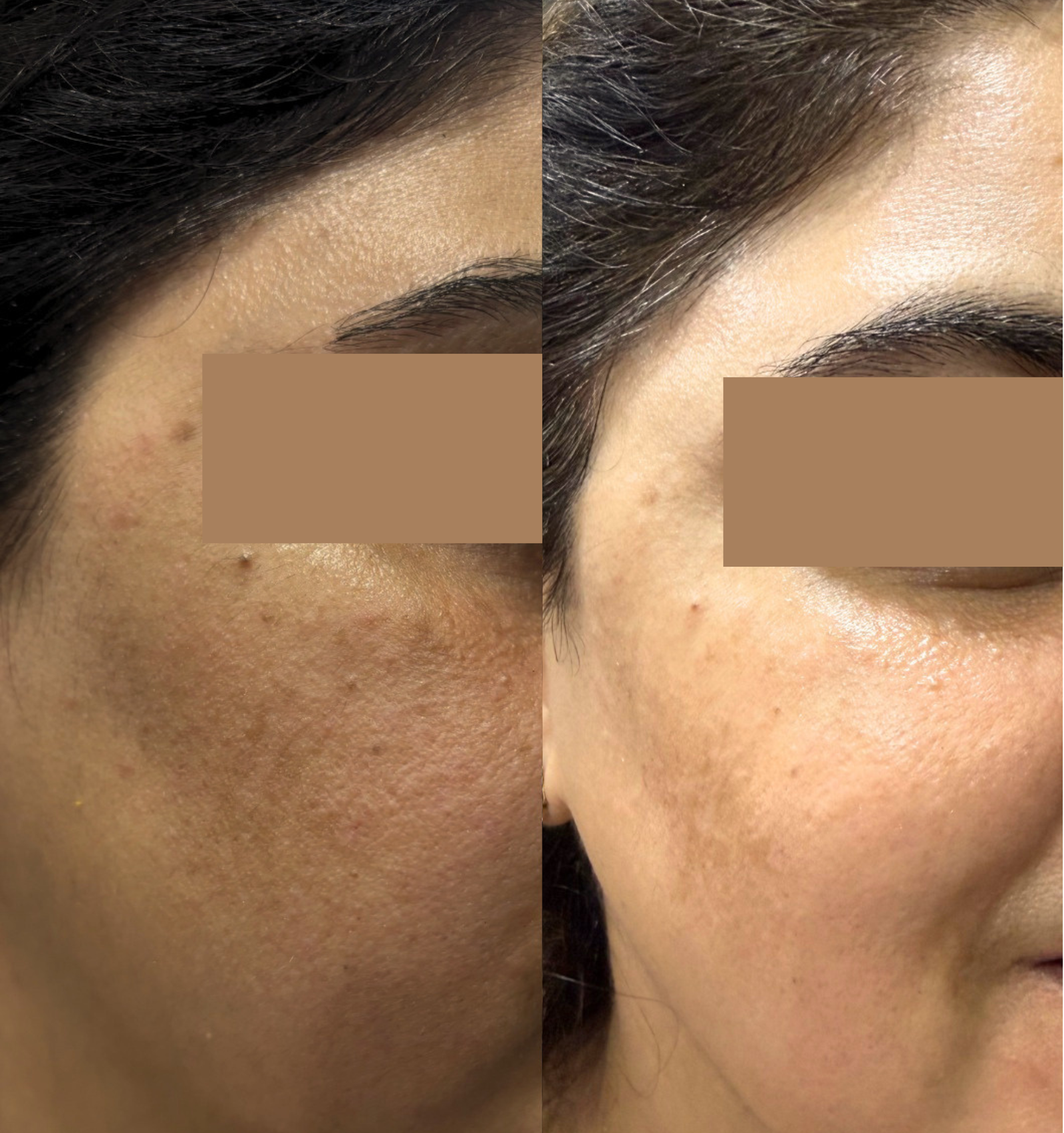 Before After &mdash; AURELIN Vitamin C Serum